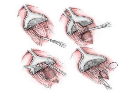 phương pháp cắt khoanh niêm mạc